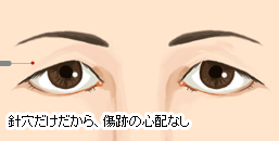 注射針をさすだけの為1ミリ前後の針穴が開くだけです。
                        傷跡や術後のハレは心配ありません。