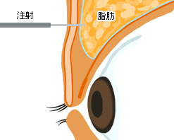 目頭も同時に切開するため、目の横幅を鼻側に広げることが可能です。