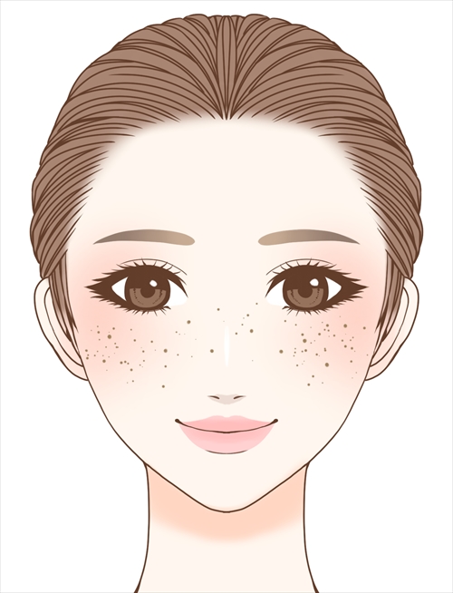 そばかす／雀卵斑