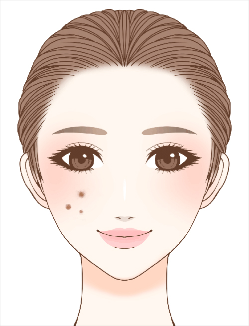 炎症後色素沈着