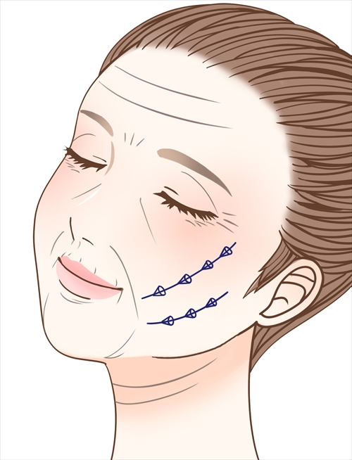 シルエットソフト（3Dリフト）