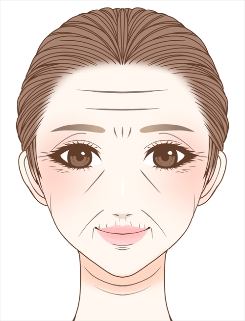 シルエットソフト（3Dリフト）術前