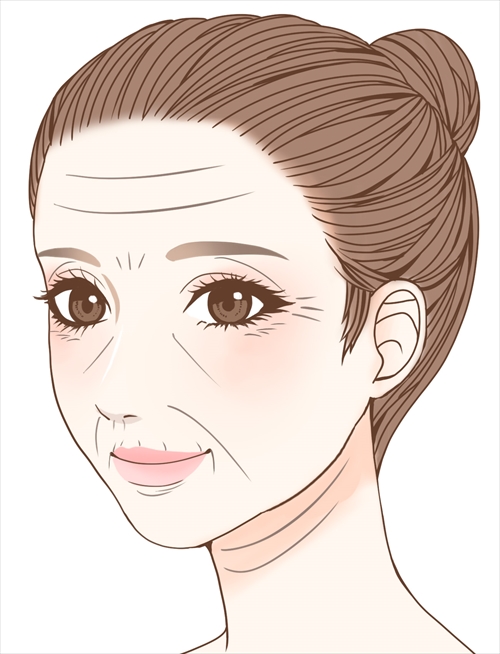 シルエットソフト（3Dリフト）術前